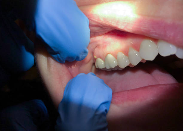 Best Emergency Dental Care for Broken or Chipped Teeth in Canal Fulton, OH