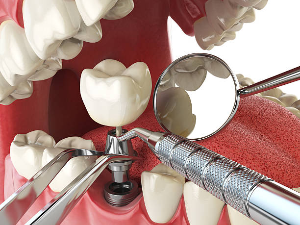 Best Emergency Tooth Extraction in Canal Fulton, OH